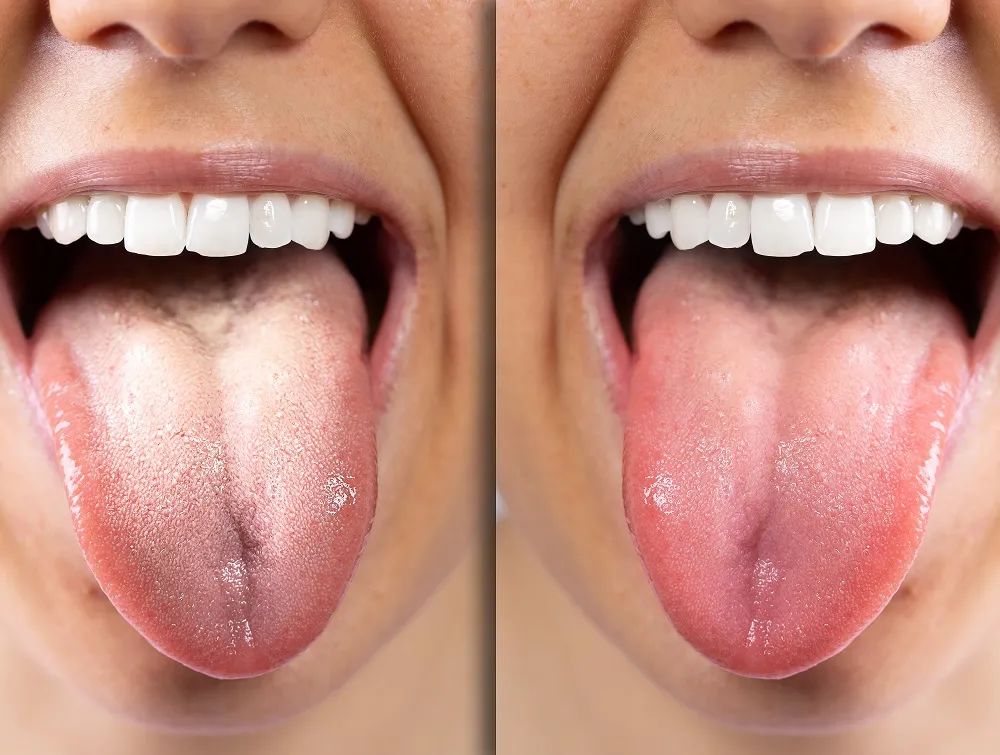 勤刷牙为啥还口臭？这13个口臭问题一次解决！ | 艾自由网